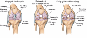 Mô tả tình trạng thoái hóa khớp gối