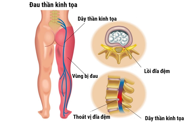 Thoát vị đĩa đệm là nguyên nhân hàng đầu gây chèn ép rễ thần kinh tọa, gây đau thần kinh tọa.