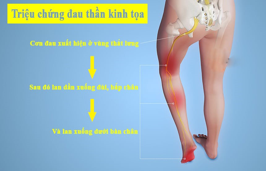 Đau thần kinh tọa gây ra cơn đau dọc theo đường đi của dây thần kinh tọa