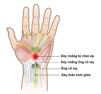 Dây thần kinh giữa bị chèn ép bởi dây chằng ngang ống cổ tay gây đau, tê giảm cám giác.