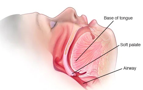 Cơ chế gây nên tình trạng ngủ ngáy ở người