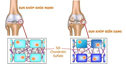 Thiếu hụt chondroitin sulfat là nguyên nhân dẫn đến các tổn thương tại sụn khớp.
